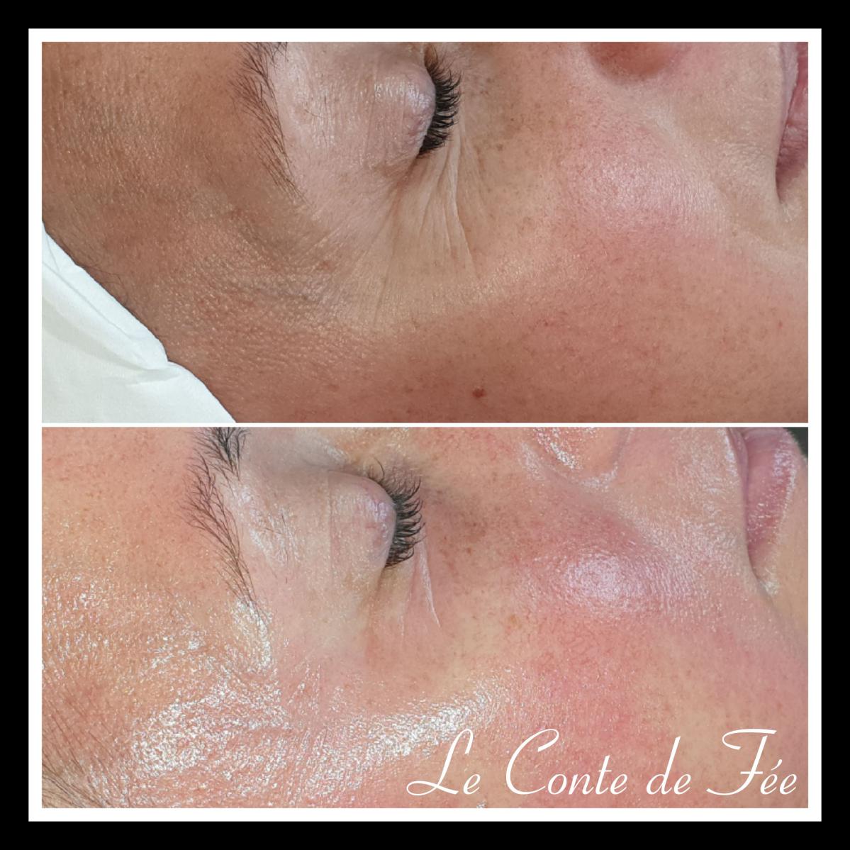 1 ERE séance Microneedling : résultats au bout de 10 minutes.