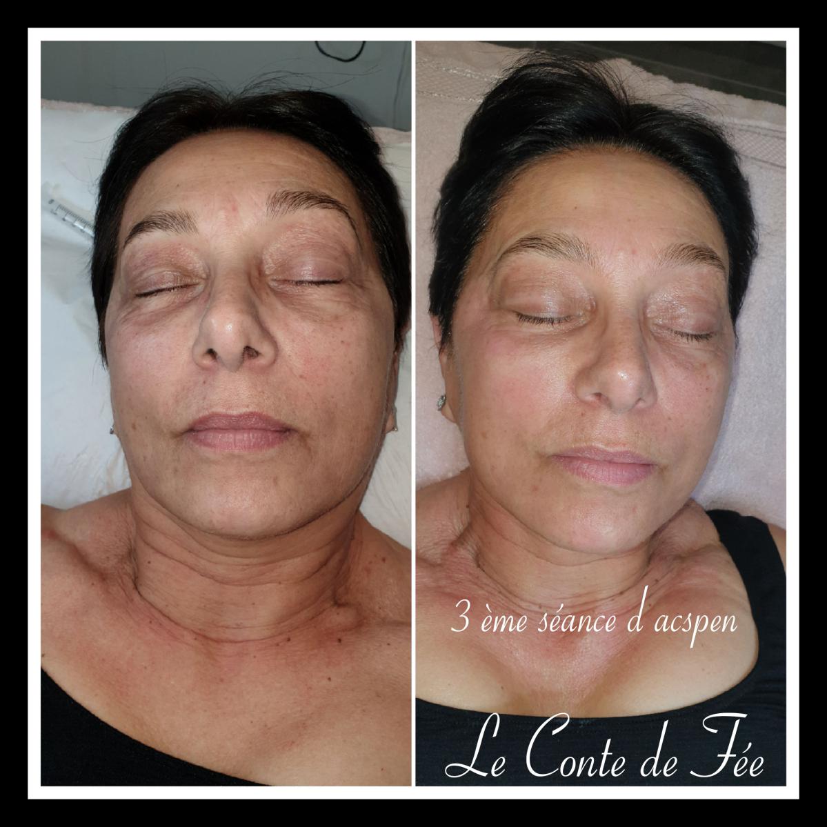 3 EME séance microneedling : nette amélioration de l'ensemble du visage et du cou.